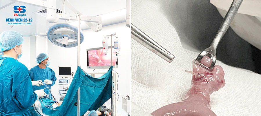 Bệnh viện 22-12 | Phẫu thuật Viêm túi thừa Meckel do xương cá đâm thủng