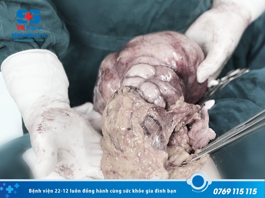 Bệnh viện 22-12 | Phẫu thuật cắt bỏ thành công khối "U quái buồng trứng" khổng lồ nặng gần 2kg