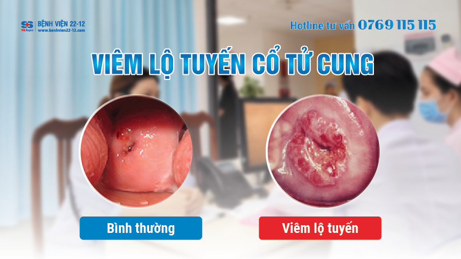 Phòng ngừa viêm lộ tuyến cổ tử cung