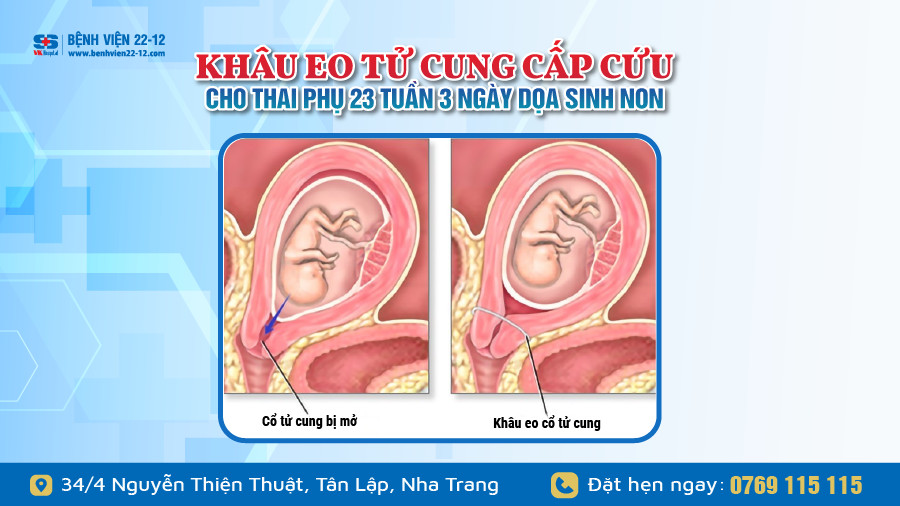 Bệnh viện 22-12 | Khâu eo tử cung cho thai phụ dọa sinh non