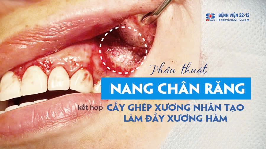 Bệnh viện 22-12 | Phẫu thuật nang chân răng