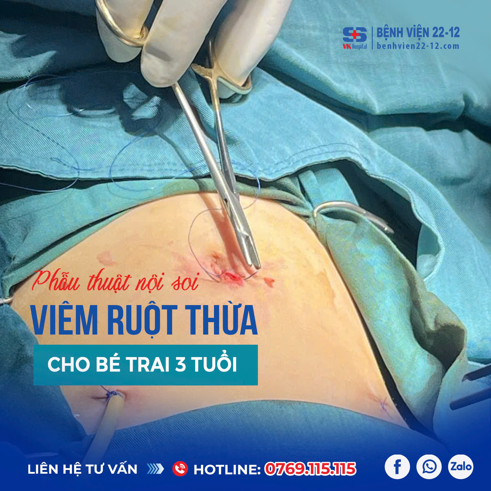 Bệnh viện 22-12| Phẫu thuật nội soi viêm ruột thừa cho bé trai 3 tuổi