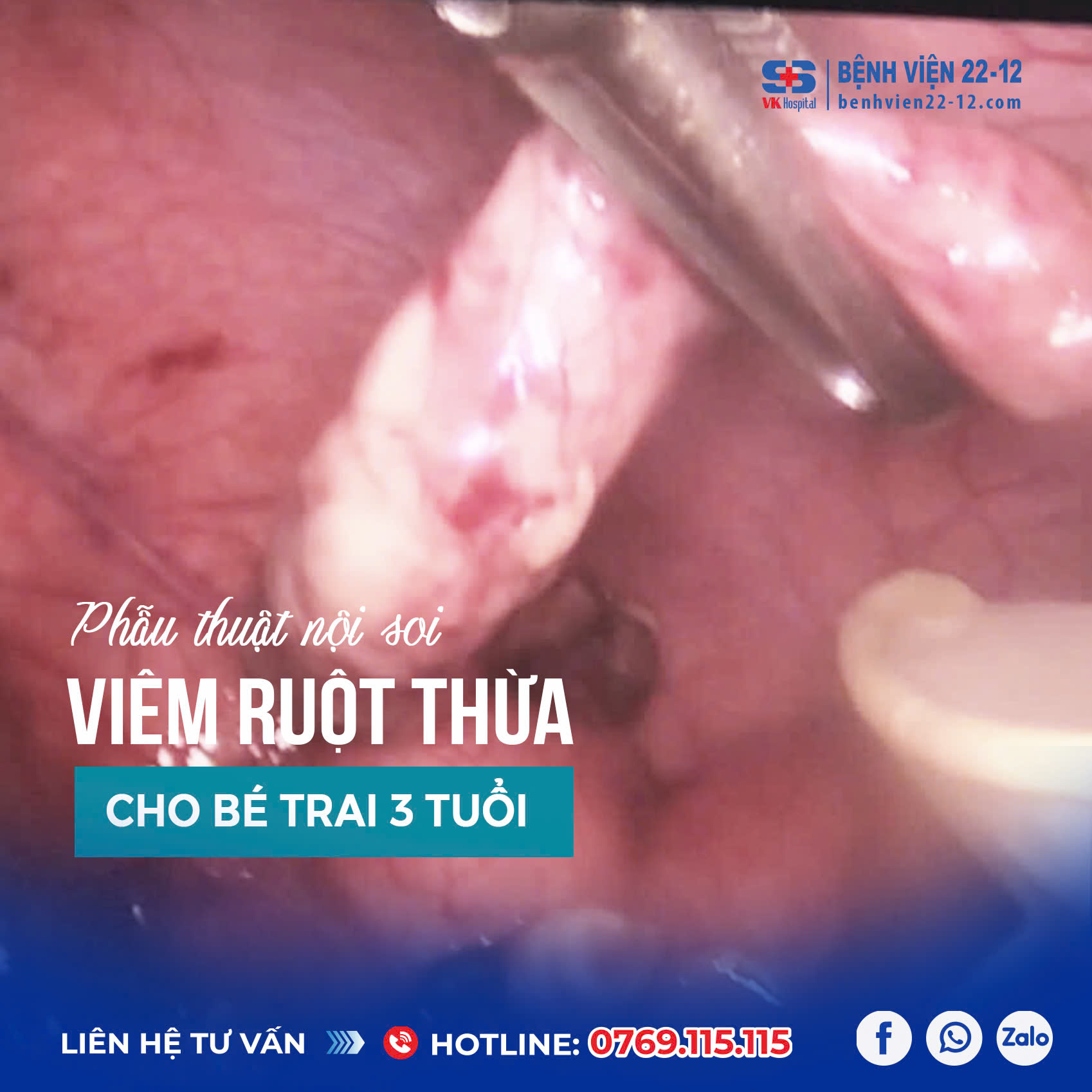 Bệnh viện 22-12| Phẫu thuật nội soi viêm ruột thừa cho bé trai 3 tuổi