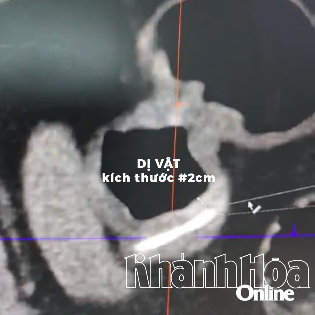 Bệnh viện 22-12 thực hiện nội soi can thiệp lấy đoạn xương cá đâm xuyên thành dạ dày cho bệnh nhân Bệnh viện 22-12 thực hiện nội soi can thiệp lấy đoạn xương cá đâm xuyên thành dạ dày cho bệnh nhân