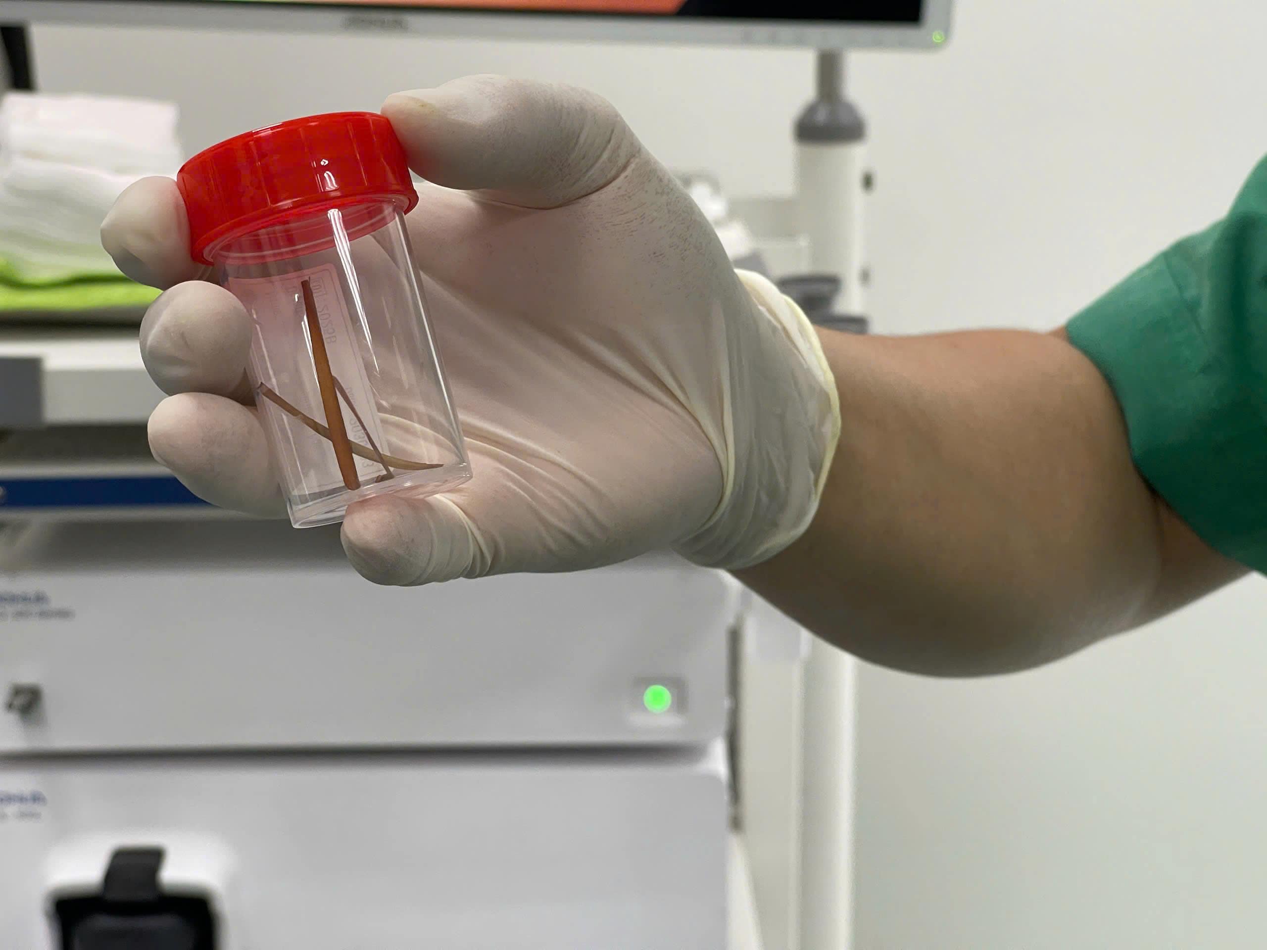 Phát hiện 3 chiếc xương dài trong đại tràng sau hơn 1 năm đau bụng âm ỉ