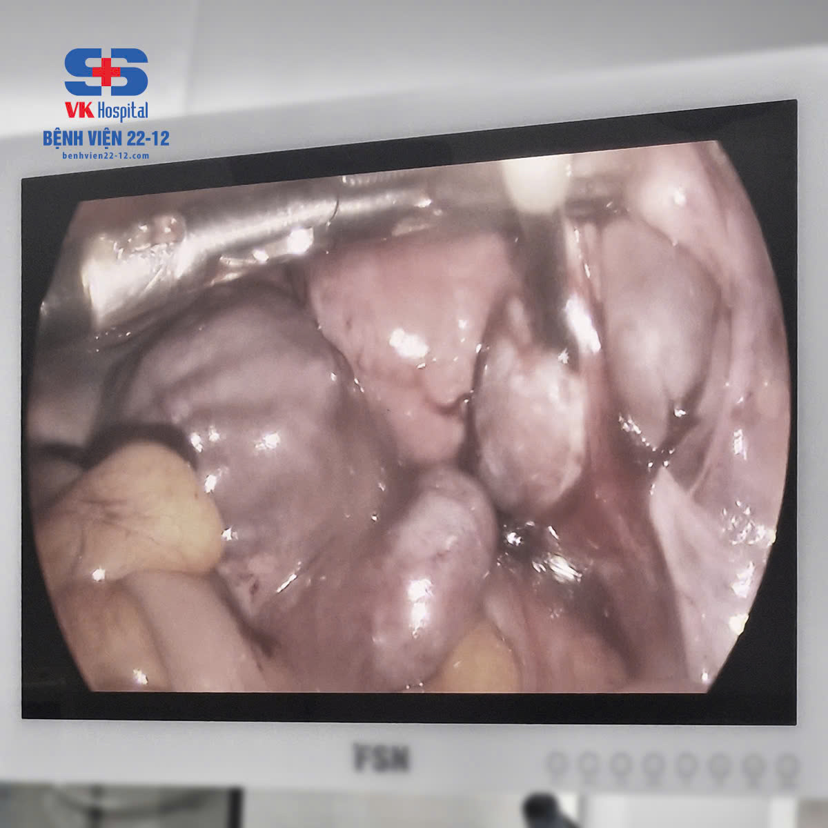 Bệnh viện 22-12 | Phẫu thuật u lạc nội mạc tử cung phức tạp